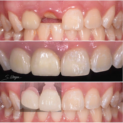 Ceramic Crowns on Tooth and Implant