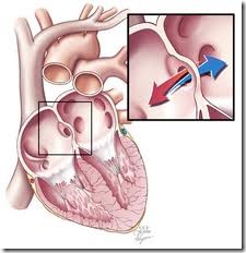 congenital heart diseases causes signs symptoms