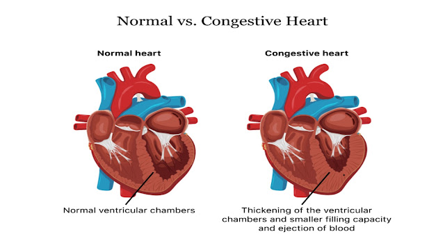 https://www.healthandfitnessexpert.in/2024/04/congestive-heart-failure-under-normal.html