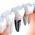 Trồng răng implant giá bao nhiêu tiền ?