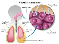 Mesothelioma Cancer :  All That You Wanted to Know About Mesothelioma Cancer