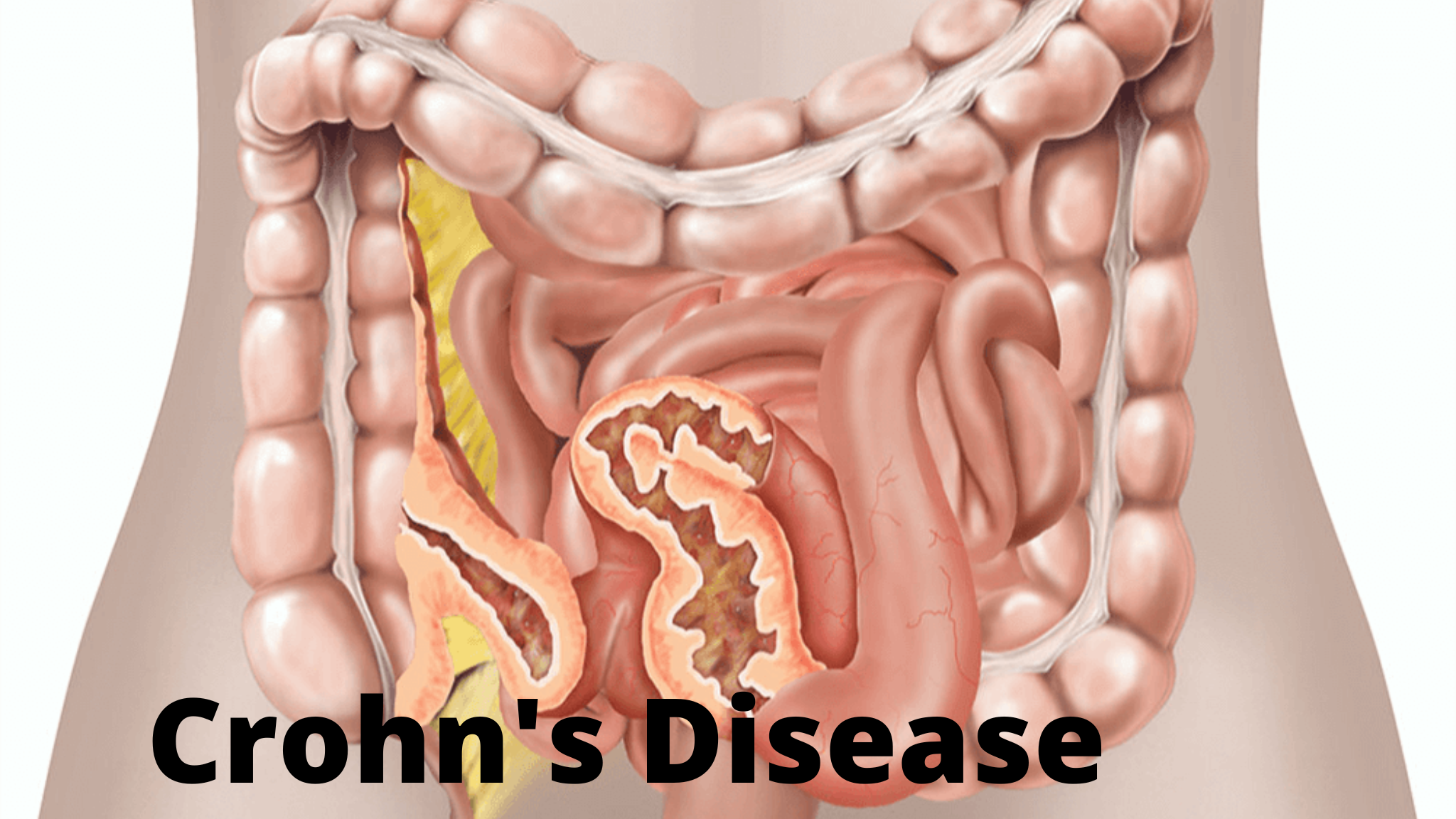 What is Crohn's Disease: Symptoms, Causes, Management And Treatment