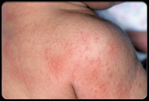 heat rash pictures. heat rashes in adults.