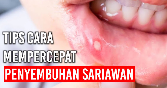 Tips cara mempercepat penyembuhan Sariawan