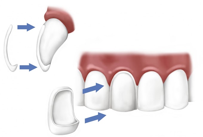 Tipos de coronas dentales y sus beneficios (Odontología)