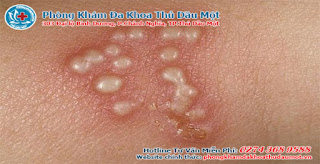 dấu hiệu nhận dạng mụn rộp sinh dục - chữa trị nam khoa