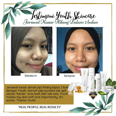 Testimoni Youth Skincare Untuk Kulit Berjerawat