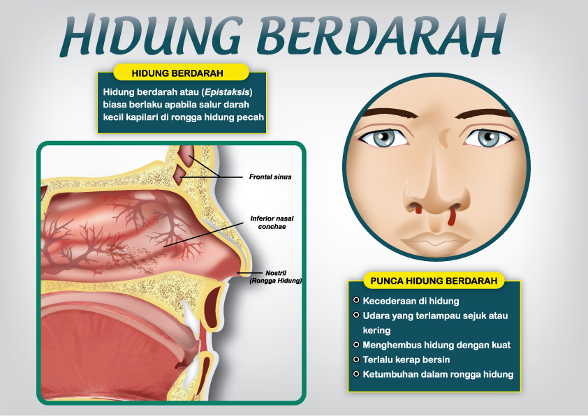 :: My 2 Cents ::: Hidung Berdarah