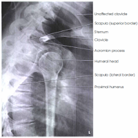 transthoracic shoulder lateral view with label