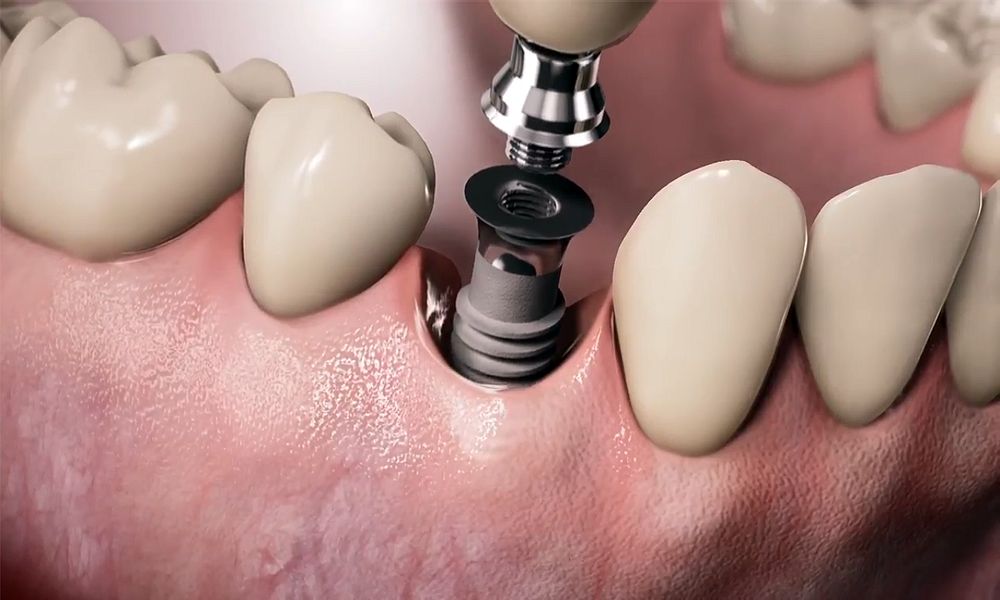 Dental Implants