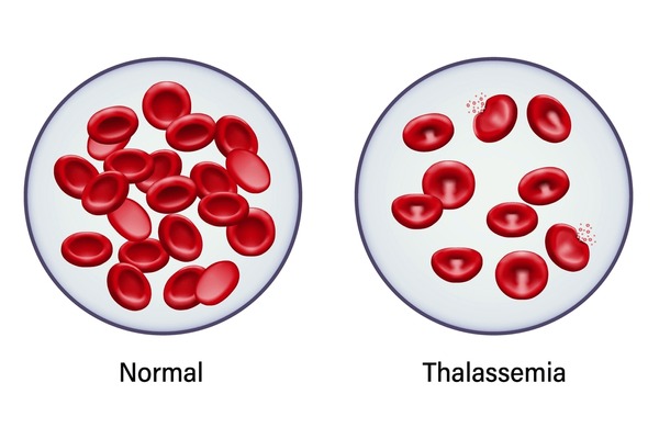An illustration of Thalassemia and non Thalassemia blood