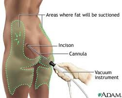 liposuccion laser,ultrasónica liposucción