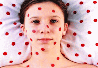 Chicken pox can not be confused with any other disease