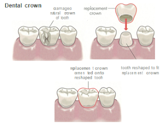 crown tooth