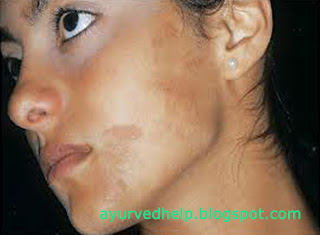 natural remedies for pigmentation on face