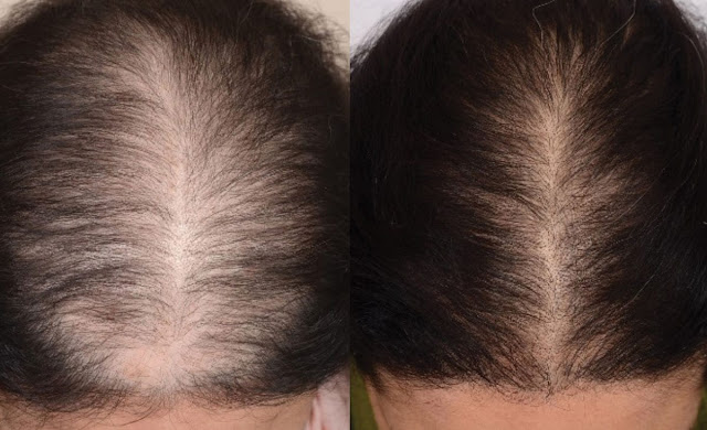 best hair loss treatment clinic in Gurgaon