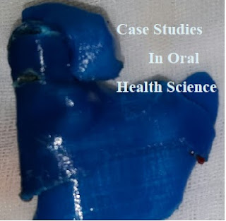 Case studies in Oral Health Science, Case studies in ENT, Case Report in ENT, Gap-arthroplasty of Tempromandibular Joint Ankylosis, Feasibilty of Preplanned Computer Guided Gap-arthroplasty, Case Report in Maxillofacial Surgery 