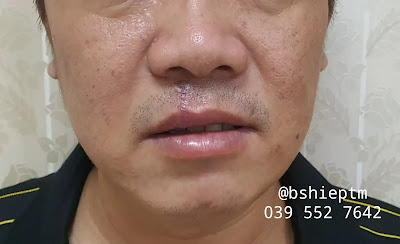 Vết thương môi trên sau mổ 2 tuần