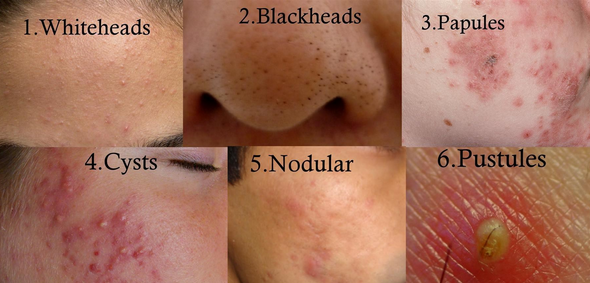 acne types