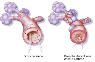 bronches et asthme