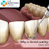 Why is dental scaling important? Says, dental surgeon