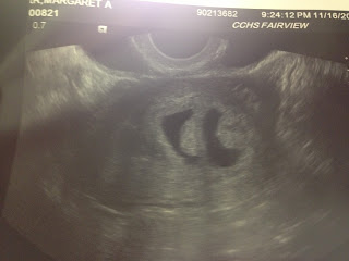 5 week twin ultrasound