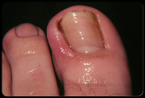 toenails of skin Ingrown the nail  into when the  toenail the occur ingrown edges shoes grow problems for