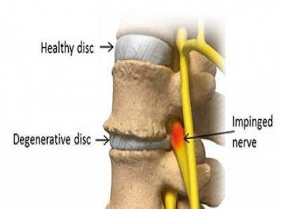 Degenerative Disc Disease Pictures