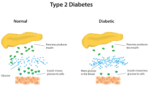 How Type 2 Diabetes Patients Can Stay Away From Medications