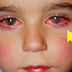Este niño perdió el 75% de la visión por culpa de un pequeño “Juguete” muy común en nuestras casas