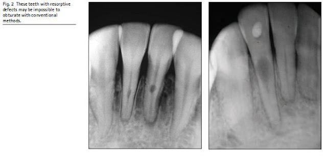 Fig. 2  These teeth with resorptive defects may be impossible to obturate with conventional methods.