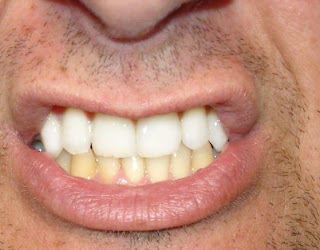 comment blanchir les dents