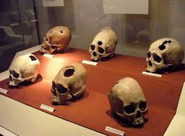 All these skulls pierced when they were alive and did not cause death.