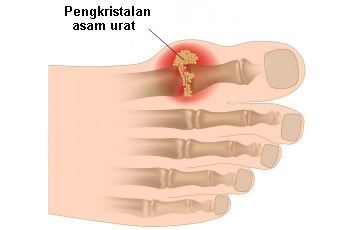 Pengkristalan asam urat