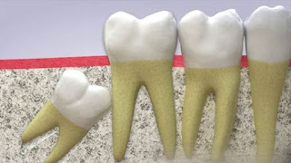 Có nên ngậm nước đá sau khi nhổ răng-1