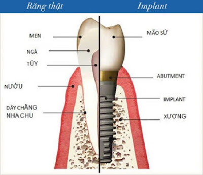 Implant nha khoa là gì?