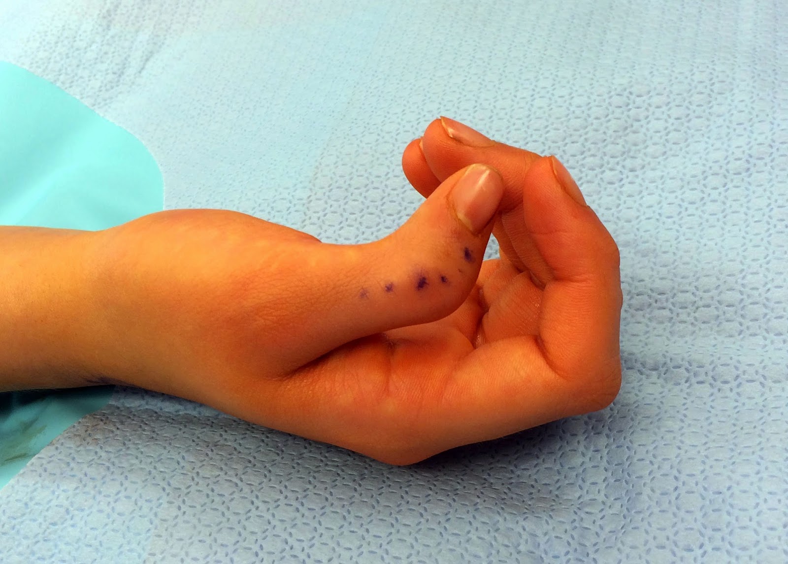 Thumb Deformity after Polydactyly Reconstruction ...