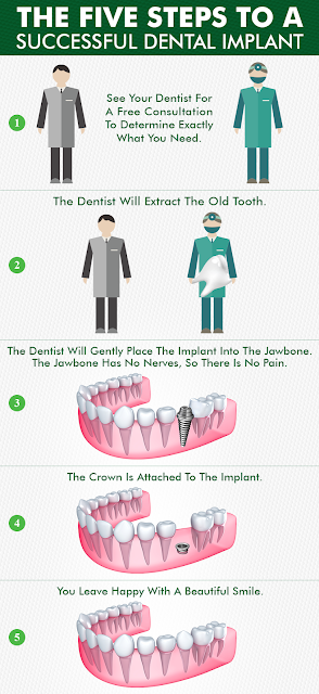 Dental Implant- Dentzz Dental