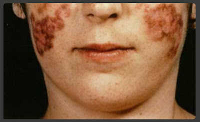 what are the symptoms of lupus