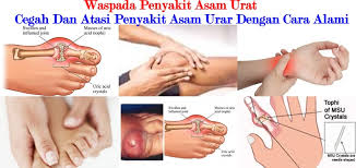 obat mujarab penyembuh asam urat