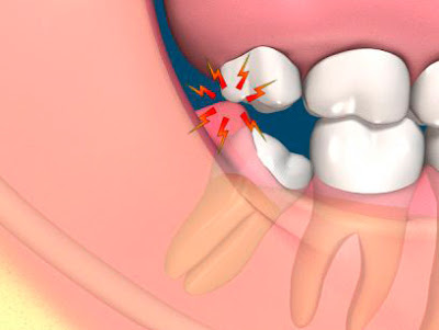 Lý giải hiện tượng mọc răng khôn bị sốt ở người trưởng thành