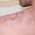   what you must know can skin cancer lead to other cancers