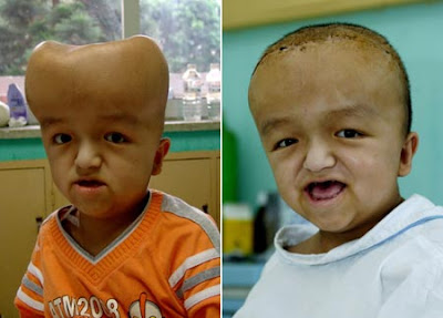 Liu Jing with a deformed skull before and after surgery