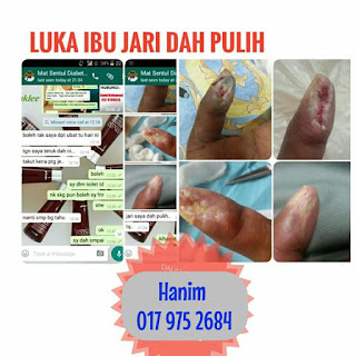 Cara Turunkan Bacaan Gula Dalam Darah Untuk Elakkan Kaki Kena Potong