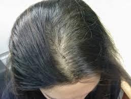 types of hair loss | hair loss causes types of | hair loss types | hair loss women types of | different types of hair loss |