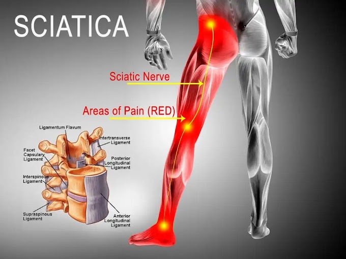 What is Sciatica, and how to treat it?