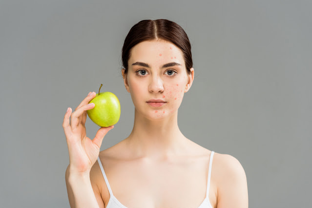 Can Diet and Stress Worsen Your Acne