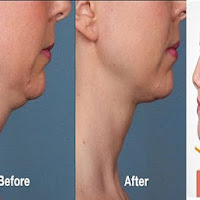 How to Get Rid Of Double Chin Fast With Face Massage 💆  Neck Fat Reduction Without Surgery