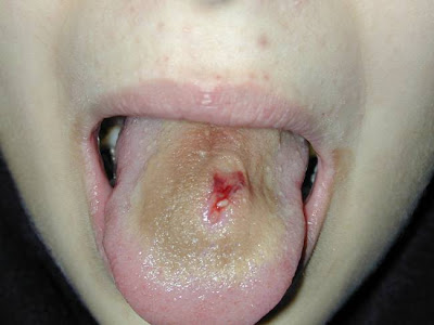 infected tongue piercings. Below is an infected tongue