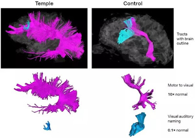 Longe de ser uma "patologia", o autismo é uma configuração cerebral sistemática inteira. "Curá-lo" implicaria descartar por completo o cérebro do autista. Descrição da imagem #PraCegoVer: Comparação colorida de duas funções neurais (que eu não entendi bem) entre o cérebro da autista Temple Grandin, com uma ampla área rosa e uma pequena área azul, e o de uma pessoa neurotípica, com a área rosa menor e a azul maior. Fim da descrição.